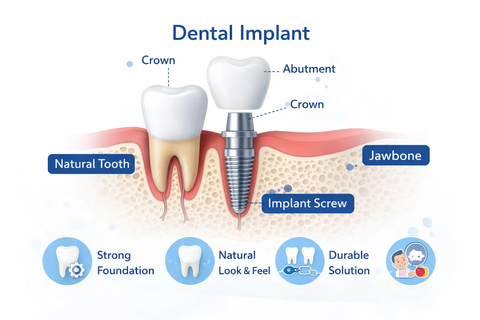Implant